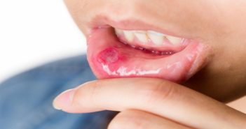 Simple & Quick Home Remedies To Treat Mouth Ulcer