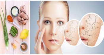 5 Home Remedies To Treat Dry Skin This Monsoon Dry Skin