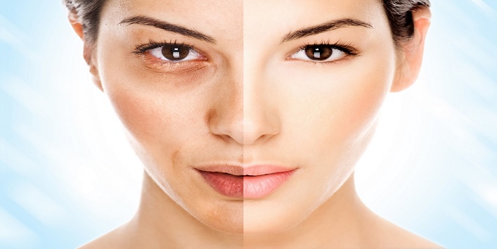 Top 5 Natural Remedies to Get Rid Of Uneven Skin Tone